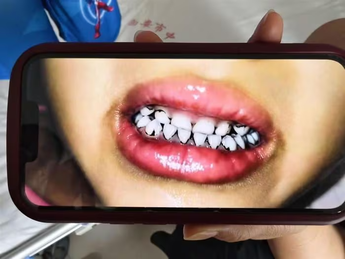 A parent shows the black substance appearing between their child’s teeth.